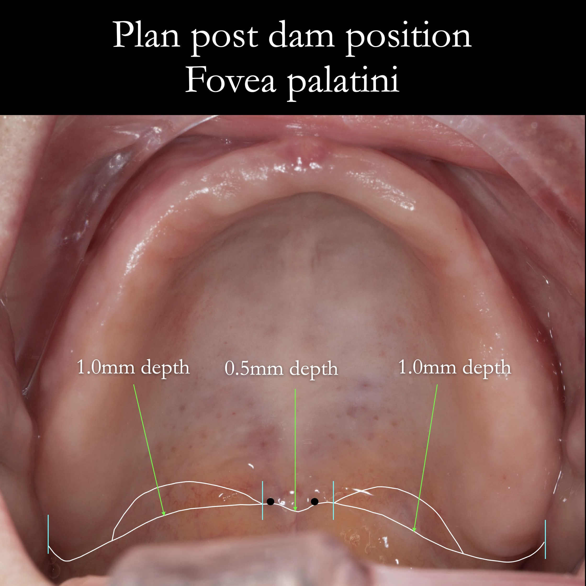 Post Dam Position For Maxillary Complete Dentures The Fovea Palatini 